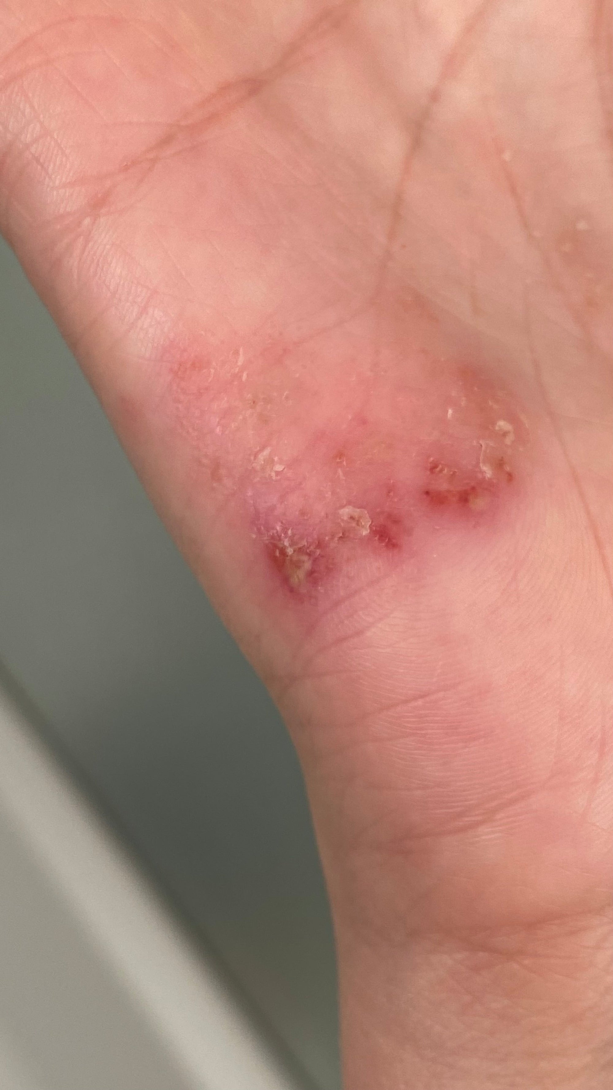 The Balm I Made for My Eczema (And Why You Might Want to Try It Too)