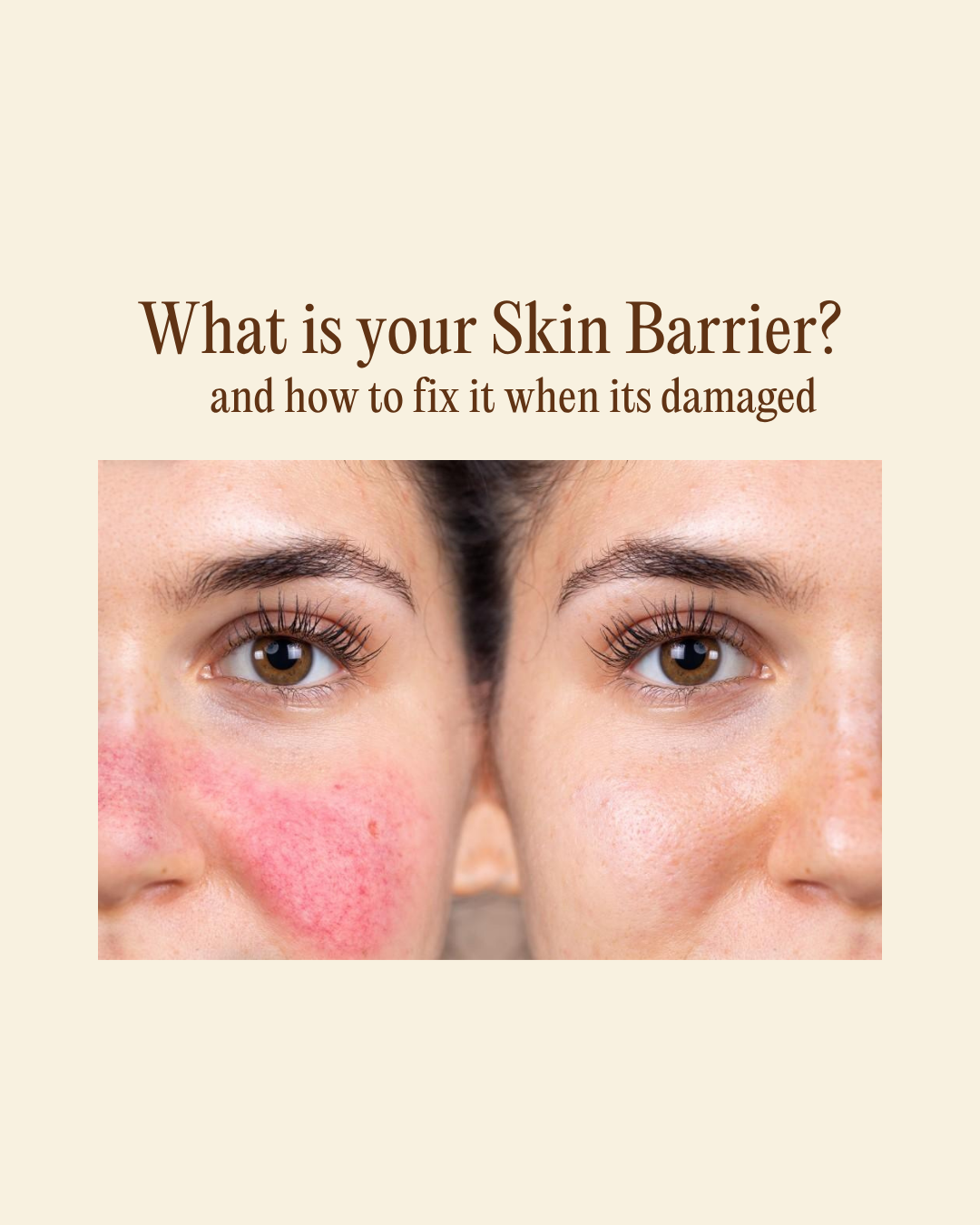 What Is Your Skin Barrier (and how to fix it when it's damaged) 🦠